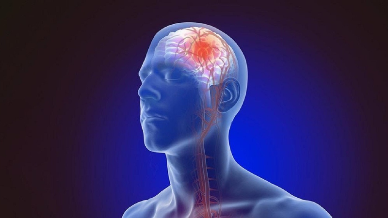 Nhồi máu não bán cấp nếu không được phát hiện kịp thời có thể gây ra những biến chứng nguy hiểm  