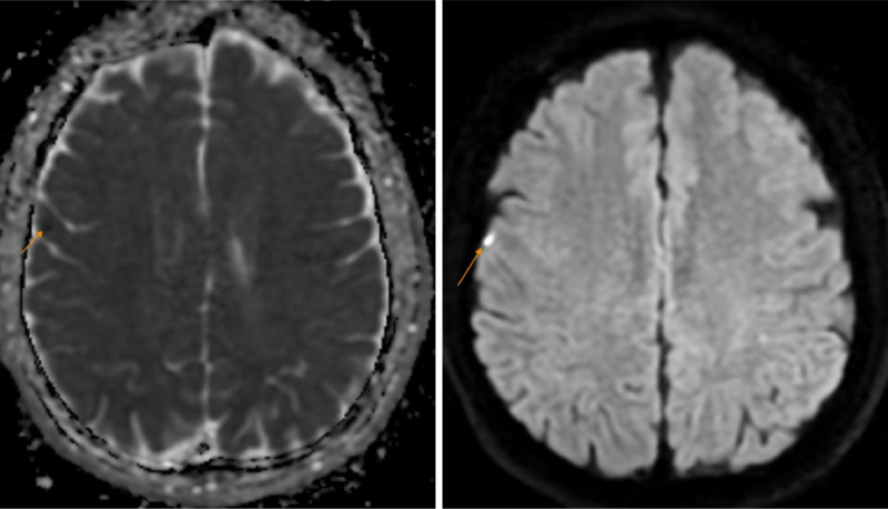 Hình ảnh tổn thương được phát hiện trên phim chụp MRI não  