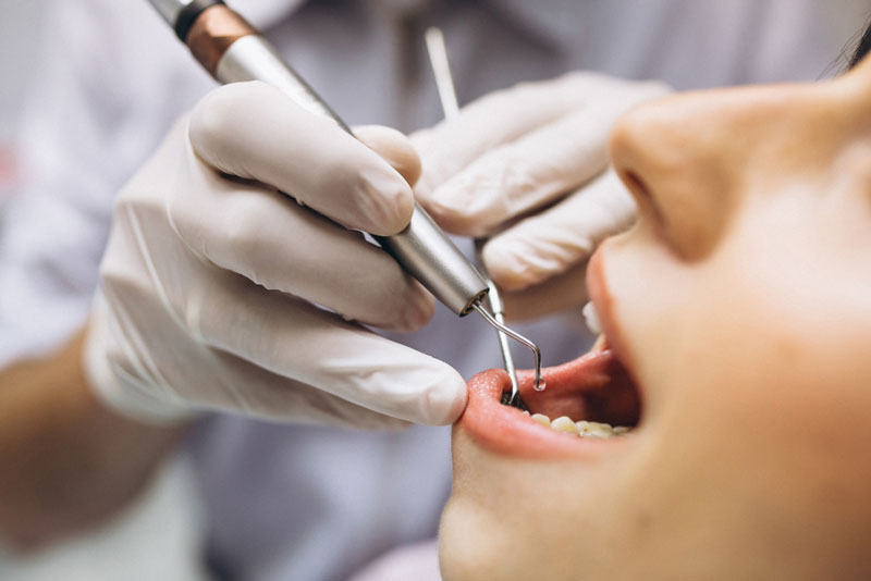 Trường hợp cần thiết, bác sĩ sẽ tiến hành lấy cao răng để loại bỏ vi khuẩn, mảng bám 