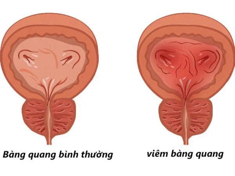 Hình ảnh minh họa bàng quang bình thường (trái) và bàng quang bị viêm (phải) 