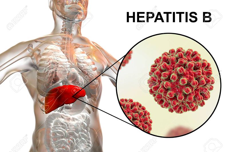Viêm gan B cấp là giai đoạn đầu tiên của bệnh viêm gan B