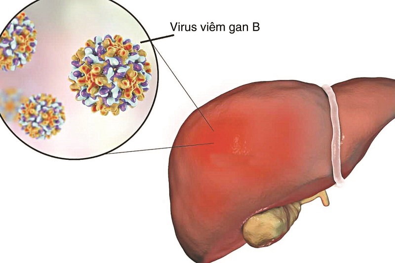 Hình ảnh minh họa lá gan bị viêm gan B