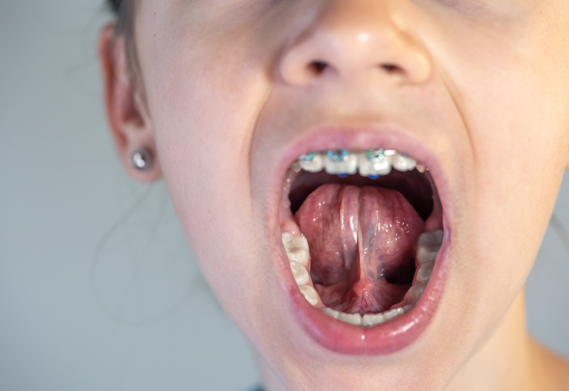 Tĩnh mạch dưới lưỡi là hệ thống mạch máu nằm sát ngay dưới lớp niêm mạc lưỡi
