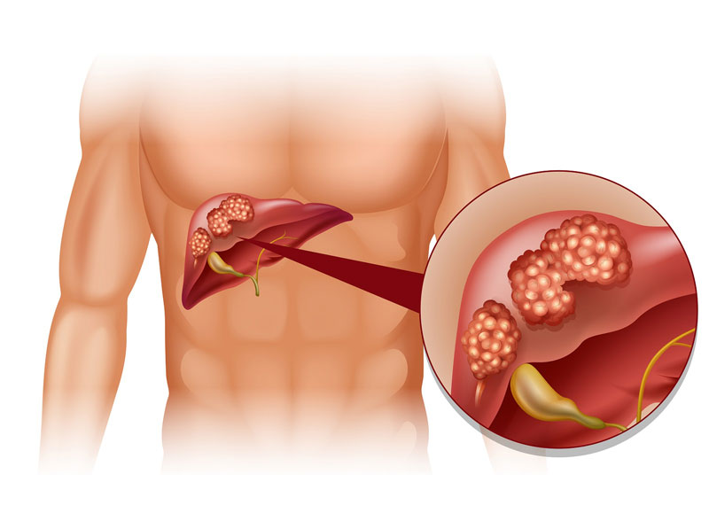 Viêm gan B là bệnh truyền nhiễm nguy hiểm
