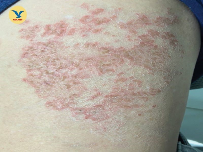 Mẩn ngứa, mề đay là một trong những bệnh lý do ký sinh trùng gây ra