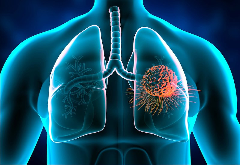 Có thuốc điều trị hiệu quả cho ung thư phổi giai đoạn 4 không?
