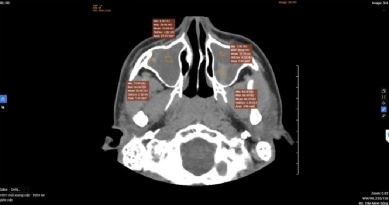 Chụp CT-scan cho thấy hình ảnh trẻ mắc viêm đa xoang độ nặng