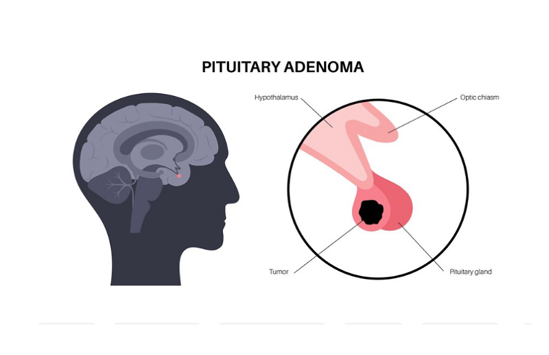 U tuyến yên có thể là u tăng tiết hormone hoặc u không tiết hormone