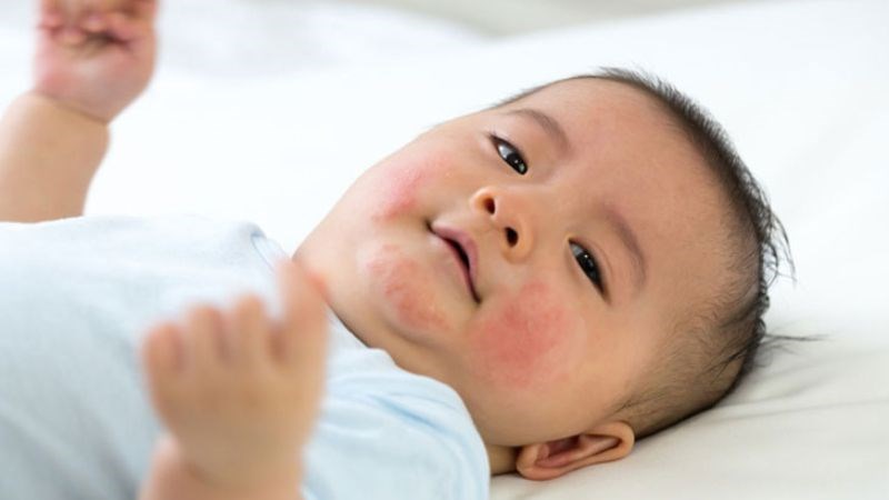 Hệ miễn dịch chưa hoàn thiện là một trong những nguyên nhân khiến trẻ bị dị ứng sữa 