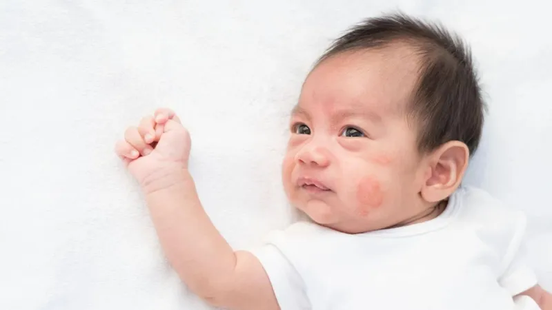 Cha mẹ cần nhận biết kịp thời những dấu hiệu trẻ bị dị ứng sữa 