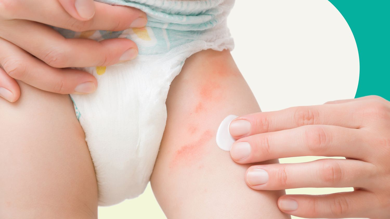 Mặc tã quá lâu là một trong những lý do khiến trẻ bị hăm da 