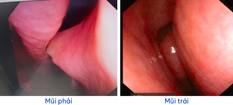    Bất thường tại mũi phải được phát hiện trên hình ảnh nội soi tai mũi họng ống mềm  