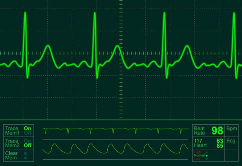 Những thay đổi trên ECG là thông điệp khẩn cấp từ trái tim đang gặp nguy hiểm