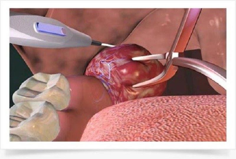 Phẫu thuật cắt Amidan bằng công nghệ Plasma (Nguồn: Internet)
