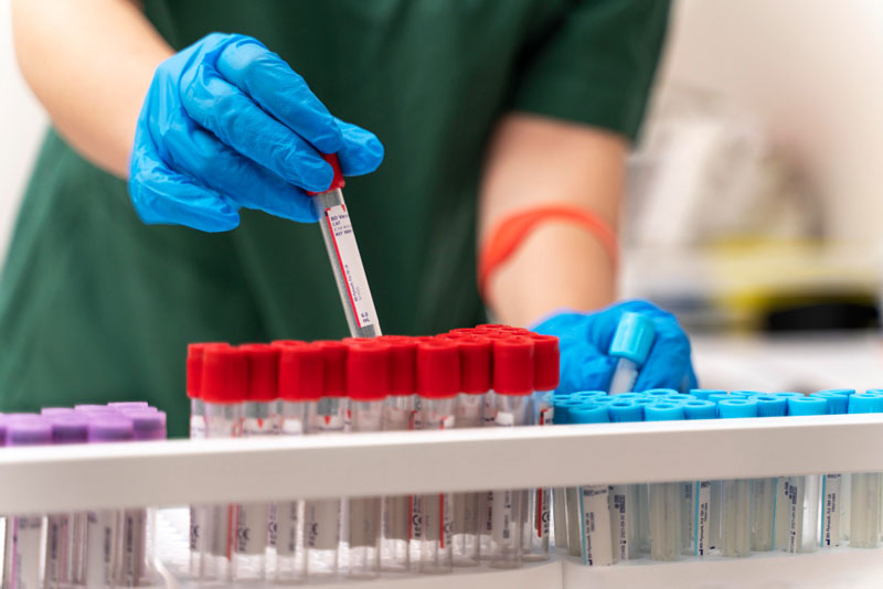 Bệnh Chikungunya có thể được chẩn đoán thông qua xét nghiệm RT-PCR