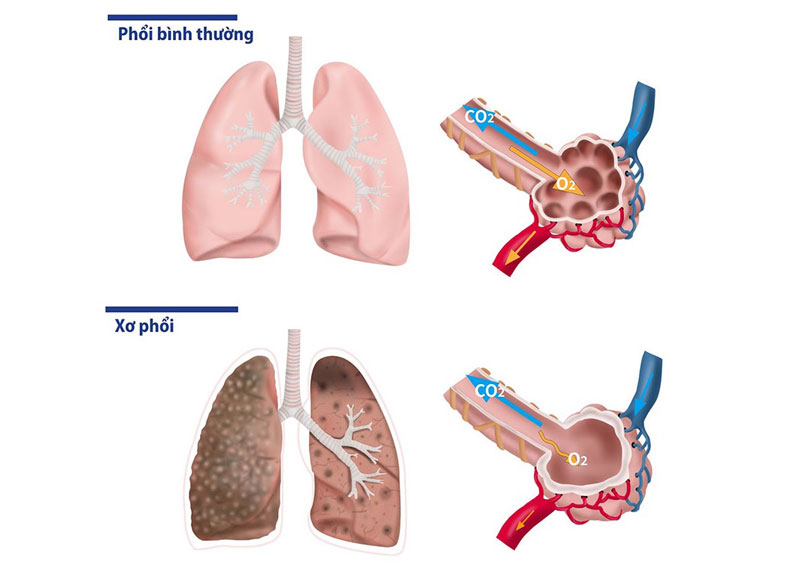 Đông đặc phổi là tình trạng nhu mô phổi bị xơ hoá, khiến phổi mất khả năng trao đổi khí