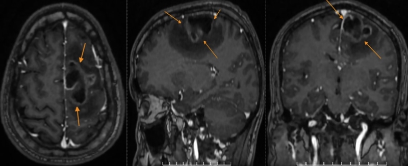 Hình ảnh tổn thương được phát hiện trên phim chụp MRI não  