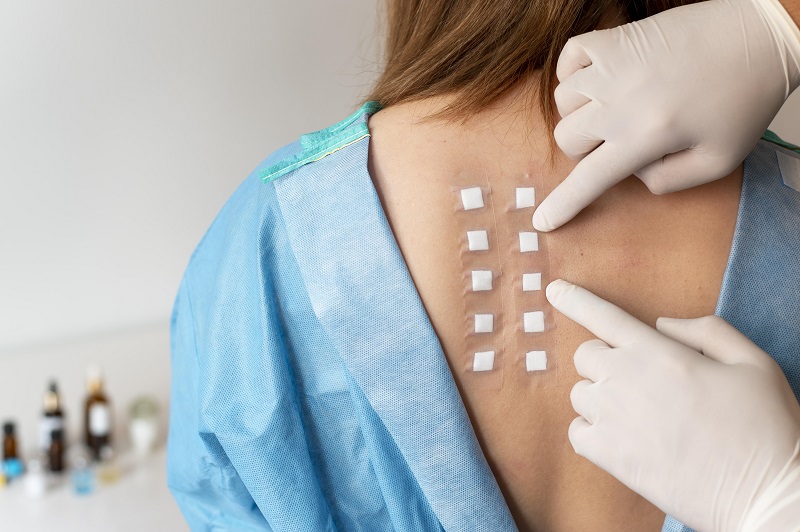 Mô phỏng cách thực hiện xét nghiệm dị ứng đạm sữa bò bằng kỹ thuật test áp da