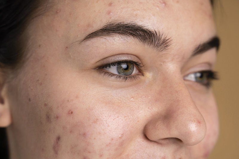 Lòng trắng mắt có đốm đen ở người lớn thường do tăng sắc tố melanin