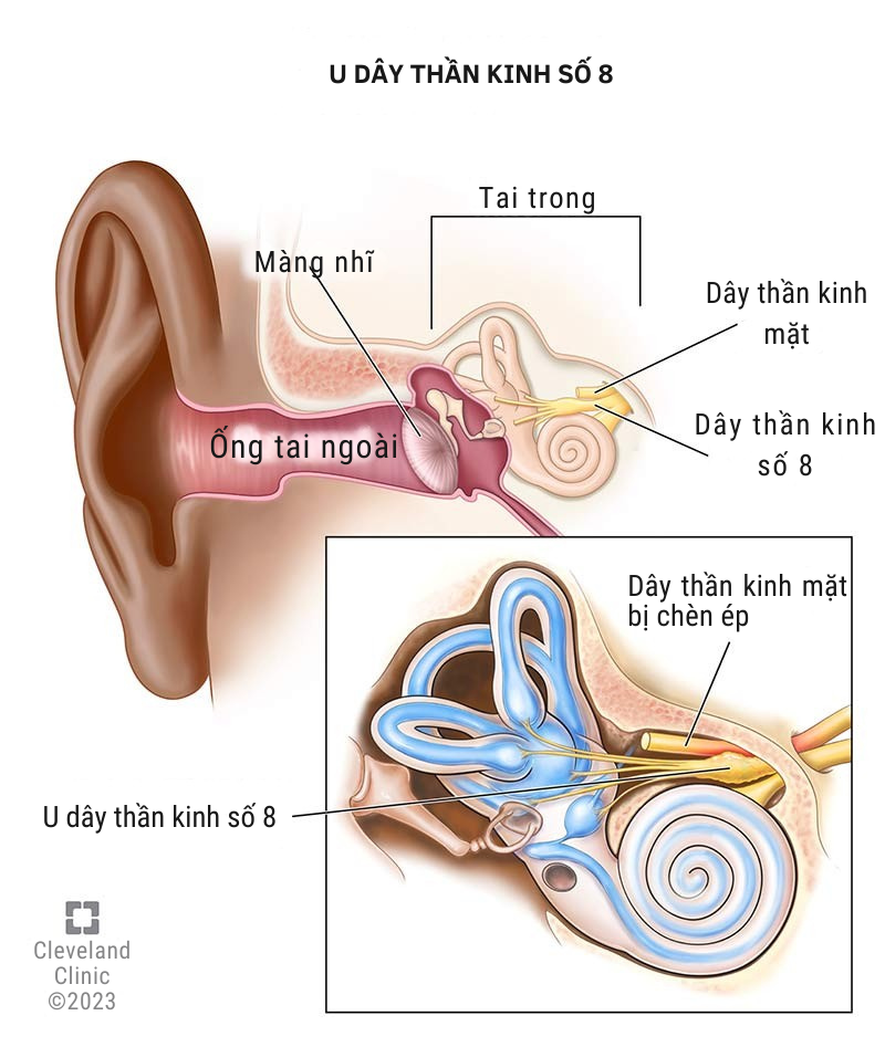 U dây thần kinh số 8 là khối u lành tính nhưng cần phẫu thuật sớm để loại bỏ khối u, giải phóng chèn ép và bảo tồn chức năng thần kinh. Ảnh minh họa 