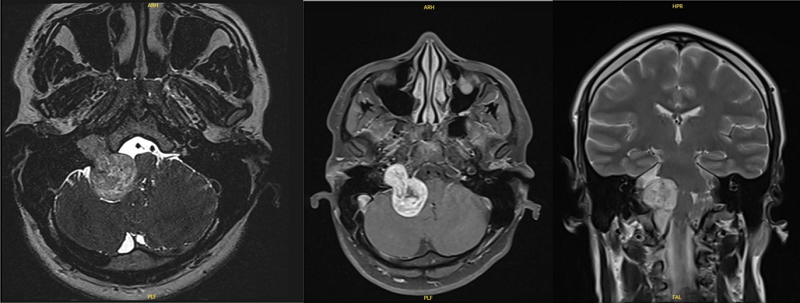 Hình ảnh chụp MRI gợi ý u dây thần kinh số 8 bên phải, khối u chèn ép não thất IV và hành não 