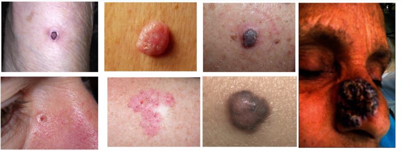 Các vị trí thường gặp ở bệnh ung thư biểu mô tế bào đáy 
