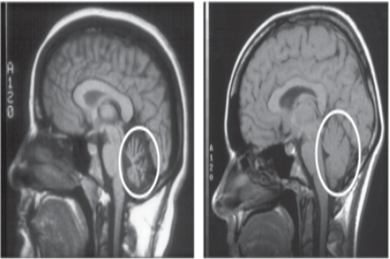 Hình chụp MRI não: hình bên trái cho thấy sự teo của tiểu não ở một người mắc SCA, hình bên phải cho thấy tiểu não bình thường.