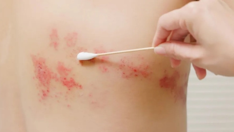 Sử dụng kem đặc trị là một trong những cách trị thâm sau zona