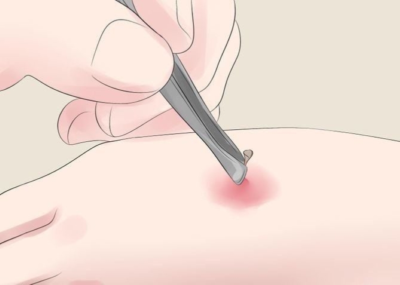 Nhanh chóng loại bỏ ngòi ong là việc làm quan trọng khi sơ cứu ong đốt 