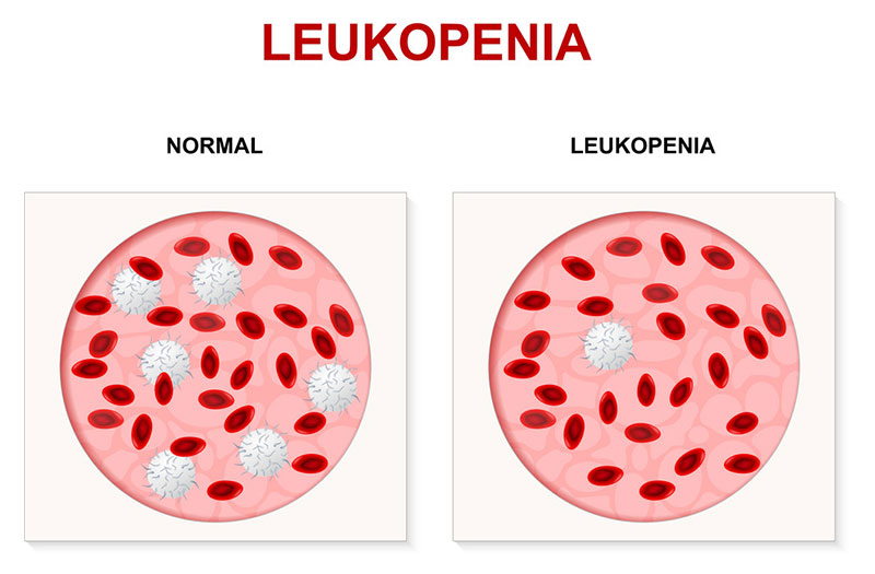 Tìm hiểu về giảm bạch cầu là bệnh gì và cách điều trị
