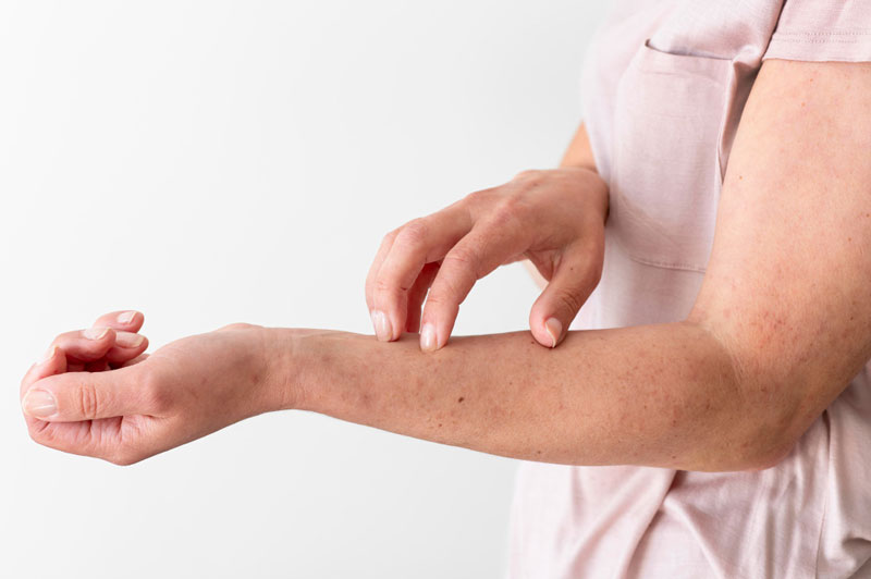 Người bị viêm da, ngứa da có thể sử dụng Clobetasol Propionate