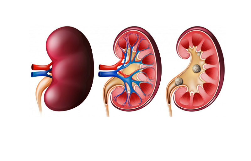 Sỏi thận lâu năm dễ gây suy thận mạn