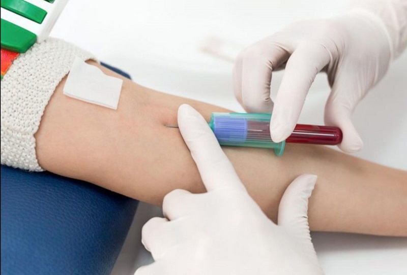  Chỉ số aso trong xét nghiệm máu và tầm quan trọng của nó