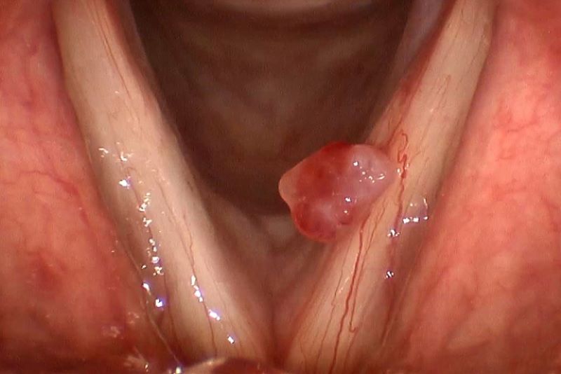 Hình ảnh papilloma thanh quản