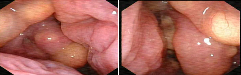 Nội soi Tai - Mũi - Họng bằng ống mềm ghi nhận hình ảnh bất thường ở mũi 