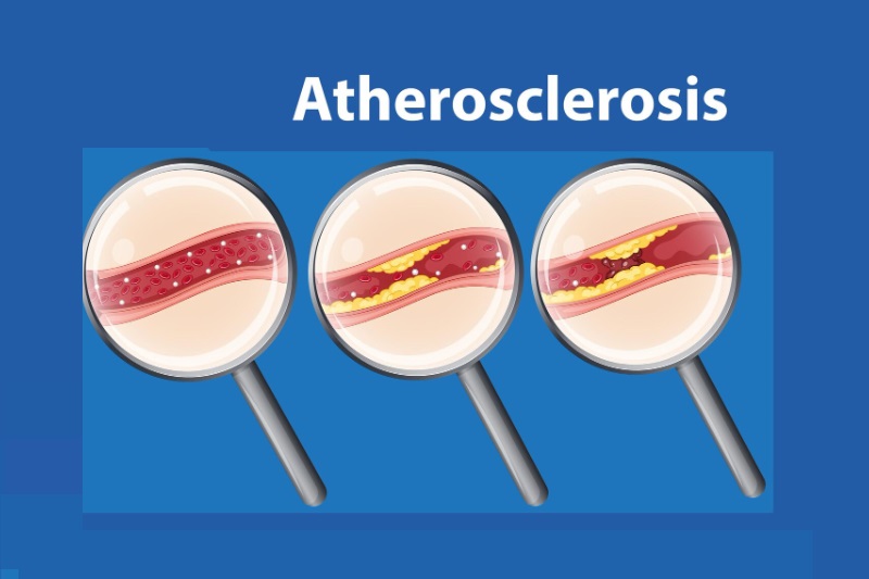 Tăng cholesterol toàn phần nếu không được kiểm soát có thể gây xơ vữa động mạch