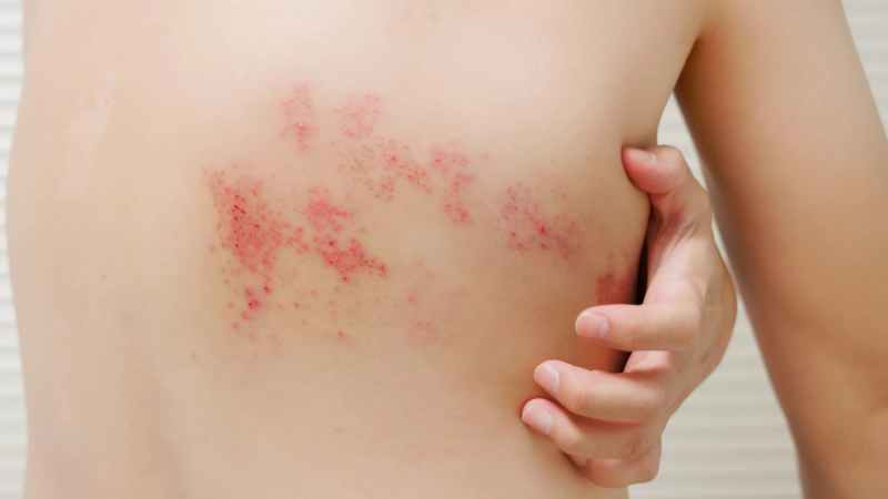 Người mắc zona thần kinh sẽ xuất hiện các mảng phát ban đỏ kèm mụn nước trên da 