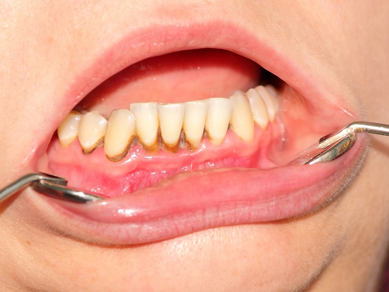 Searching for methods to remove black dental plaque on teeth.