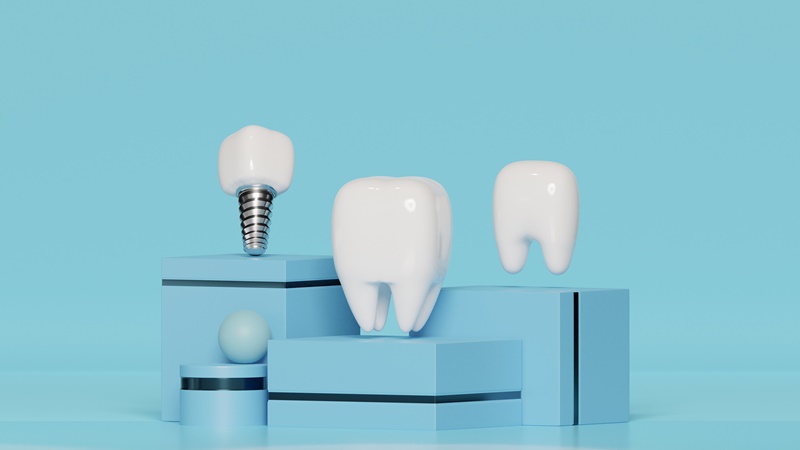Mức giá của mỗi phương pháp trồng răng sẽ khác 