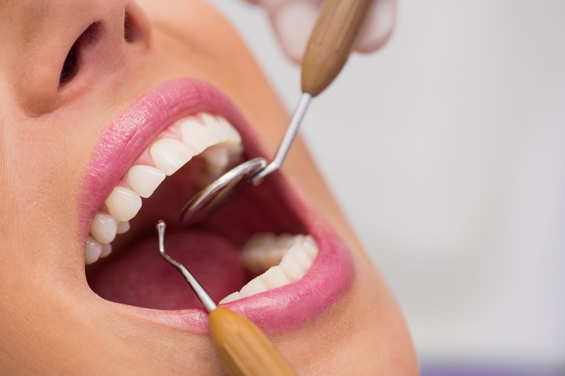 Cao răng là những mảng bám thường có trên thân răng và mép lợi