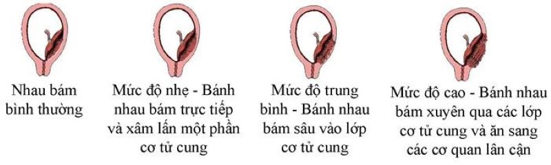 Hình ảnh mô tả tình trạng nhau cài răng lược (Nguồn: Sưu tầm Internet)