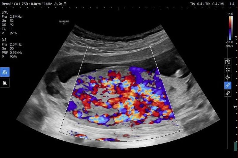 Hình ảnh siêu âm thai của bệnh nhân cho thấy tình trạng nhau cài răng lược