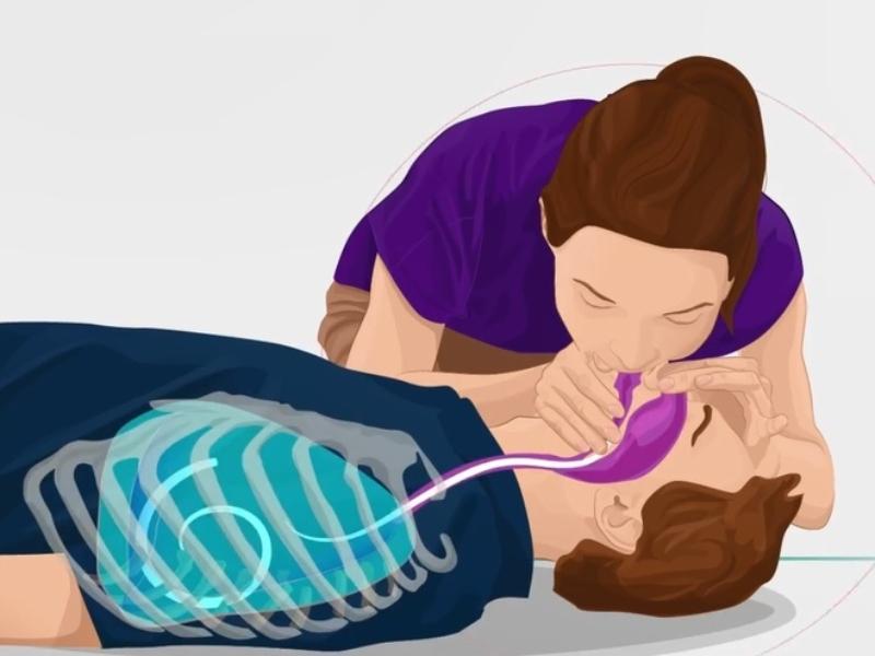 Không hô hấp nhân tạo trong quá trình sơ cứu động kinh 