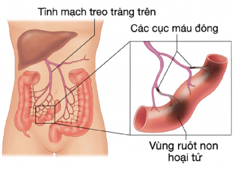 Phình tách động mạch mạc treo tràng trên nếu không điều trị kịp thời có thể dẫn tới biến chứng nghiêm trọng 
