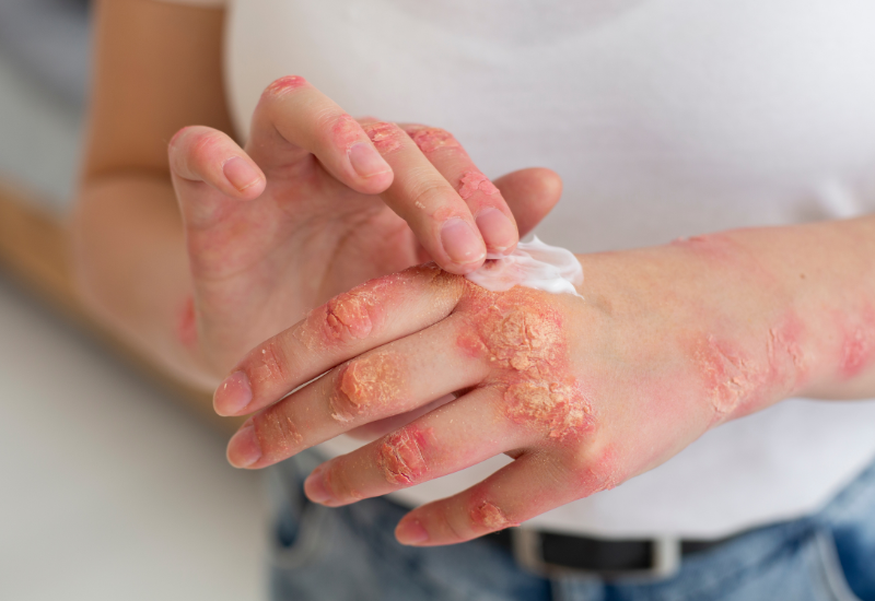 Bác sĩ thường chỉ định xét nghiệm vi nấm soi tươi trong trường hợp người bệnh có dấu hiệu nghi ngờ nhiễm nấm
