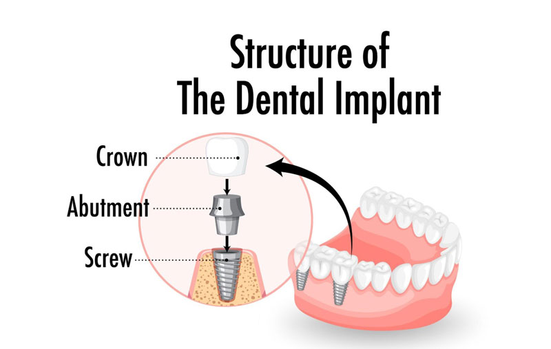 Minh họa kỹ thuật implant nha khoa 