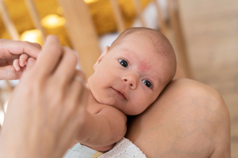 Nhiều ba mẹ thường lầm tưởng trẻ sơ sinh bị nám da mặt