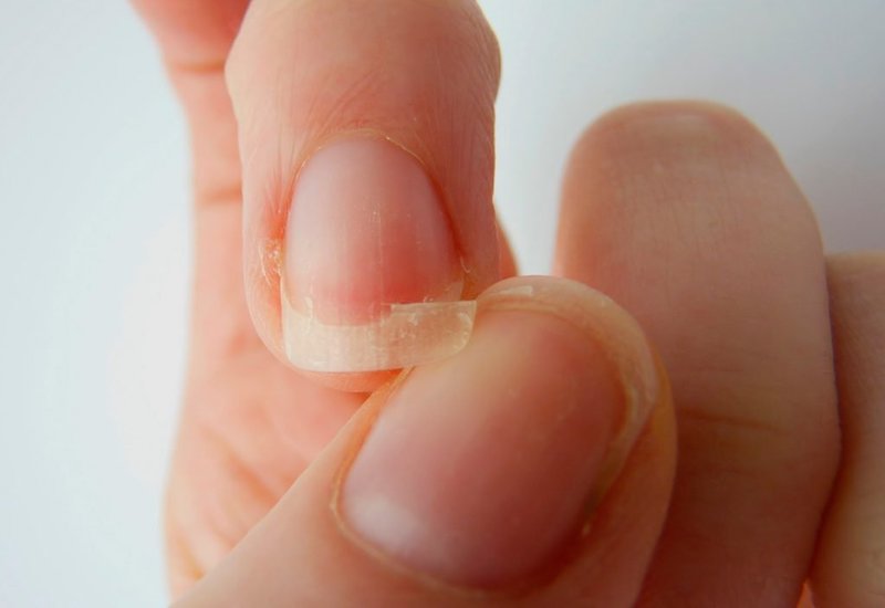 Liệu việc điều trị gãy ngón tay có cần một quá trình phẫu thuật không? 
