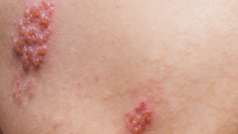 Việc vệ sinh vết zona thần kinh sẽ giúp giảm nguy cơ nhiễm trùng 