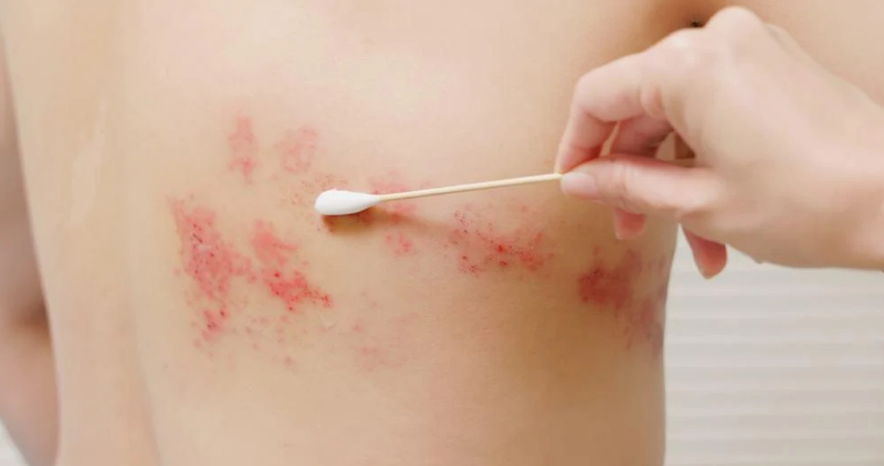 Cần áp dụng cách vệ sinh vết zona thần kinh theo từng giai đoạn 